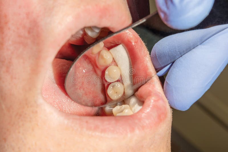 Restoration of the molar of a human tooth with filling material. The concept of aesthetic restorative dentistry in a dental clinic stock photography