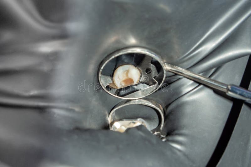 Restoration of the molar of a human tooth with filling material. The concept of aesthetic restorative dentistry in a dental clinic stock photo