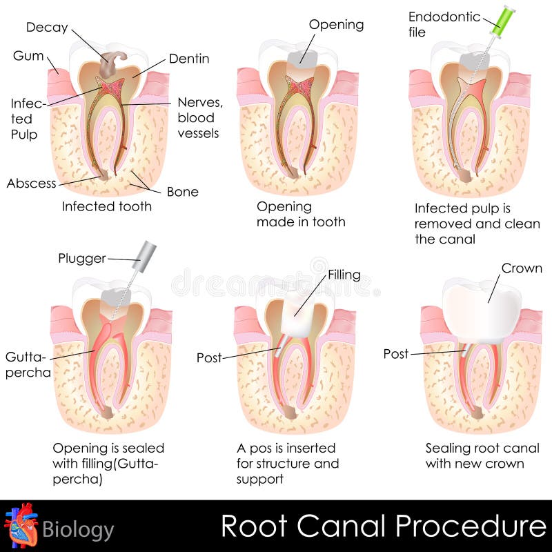 Root Canal Procedure royalty free illustration