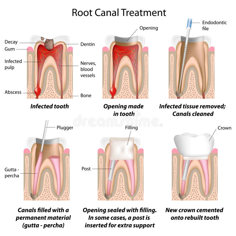 Root canal treatment royalty free illustration