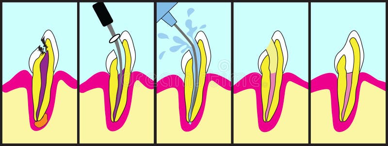 Root Canal Treatment royalty free illustration