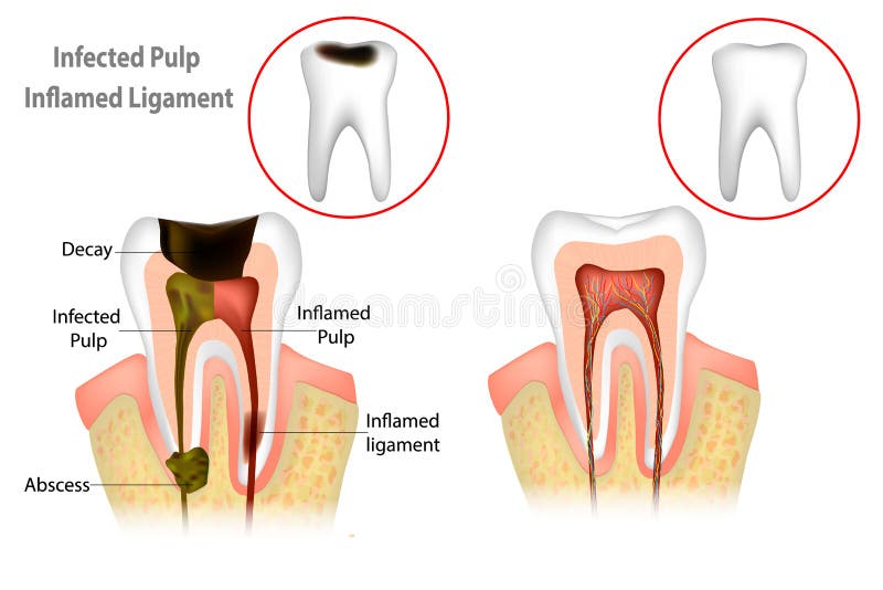 Root Canal Treatment. Infected Pulp and Inflamed Pulp royalty free illustration