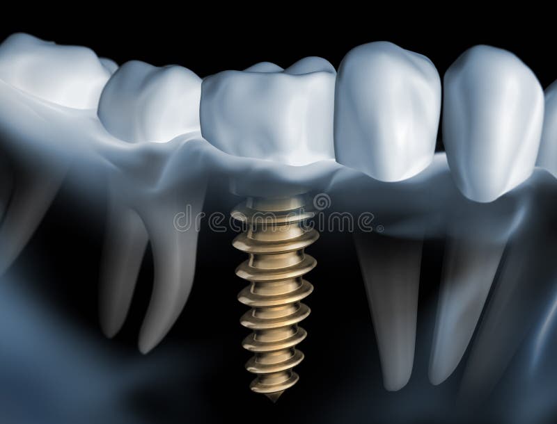 Closeup of dental implant in jaw. A row of teeth with a  crown and a metal dental implant in jaw vector illustration
