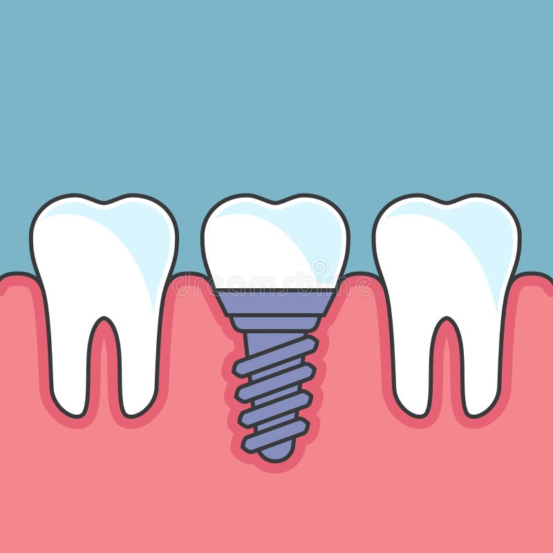Row of teeth with dental implant - prosthetics. Row of teeth with dental implant - dental prosthetics stock illustration