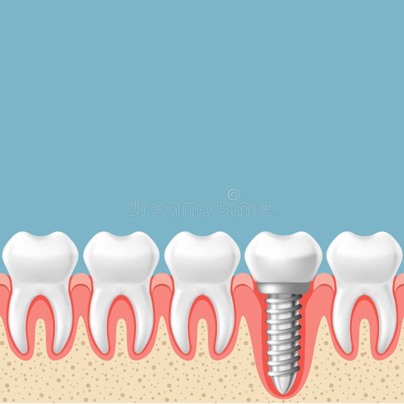 Row of teeth with dental implant - teeth prosthetics scheme. Gum cut vector illustration