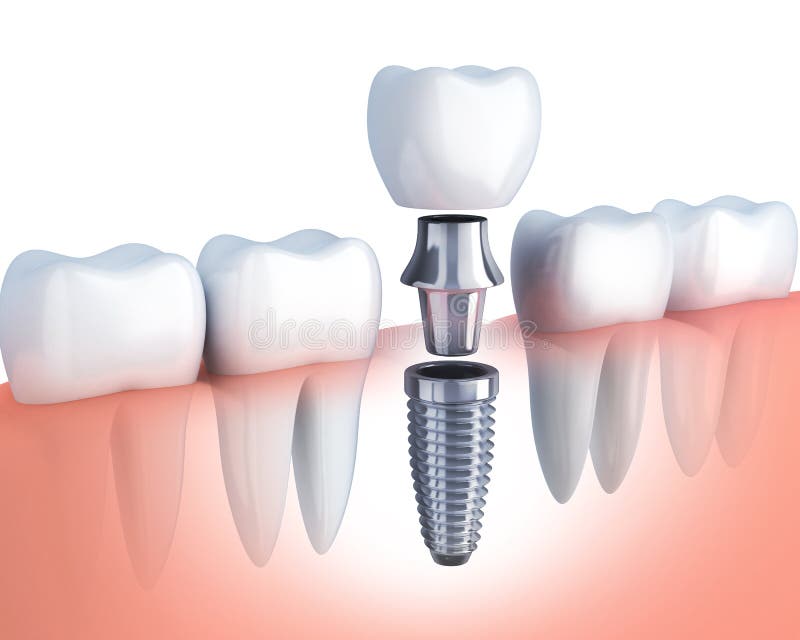 Row tooth and Dental implant. Row human tooth and Dental implant. 3d illustration stock illustration