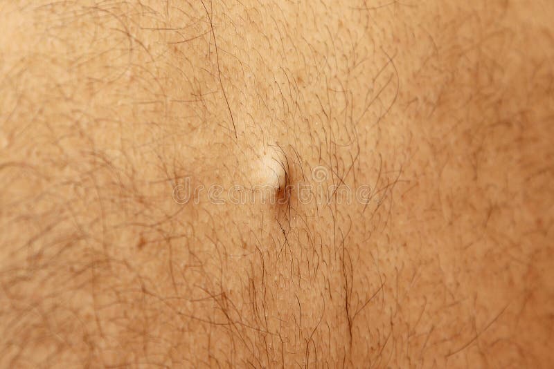 Sebaceous cyst on the back of the male. Sebaceous cyst filled bump on the back of the male royalty free stock photo