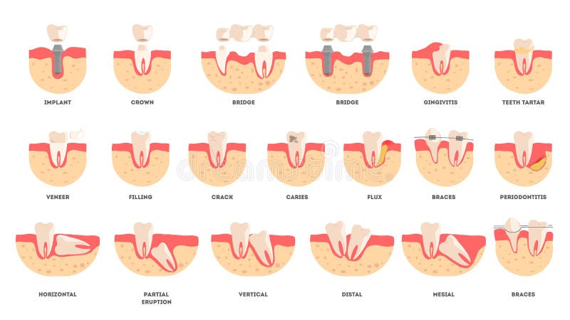 Set of human teeth in diffrent condition. Dental health and disease concept. Idea of oral health and medical treatment. Isolated illustration in cartoon style vector illustration