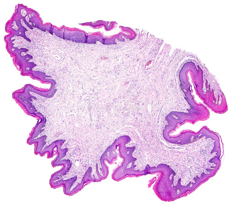 Skin papilloma of a human. Highly detailed panorama. Photomicrograph as seen under the microscope, 10x zoom stock photography