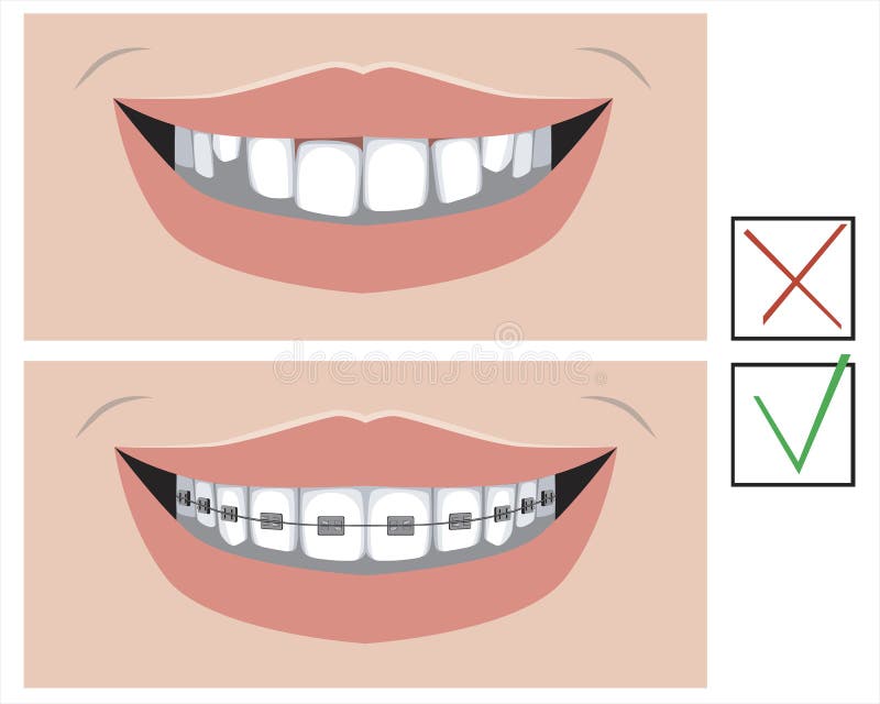 A smile with crooked teeth and with metal braces before and after the dental clinic, a vector stock illustration with molars as a. A smile before and after stock illustration