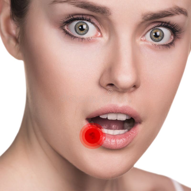 Sore on the female lips royalty free stock photos