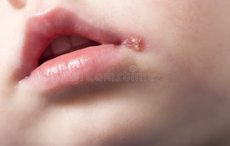 Sore on the lip of the child herpes. Sore on the lip of the child . herpes royalty free stock images