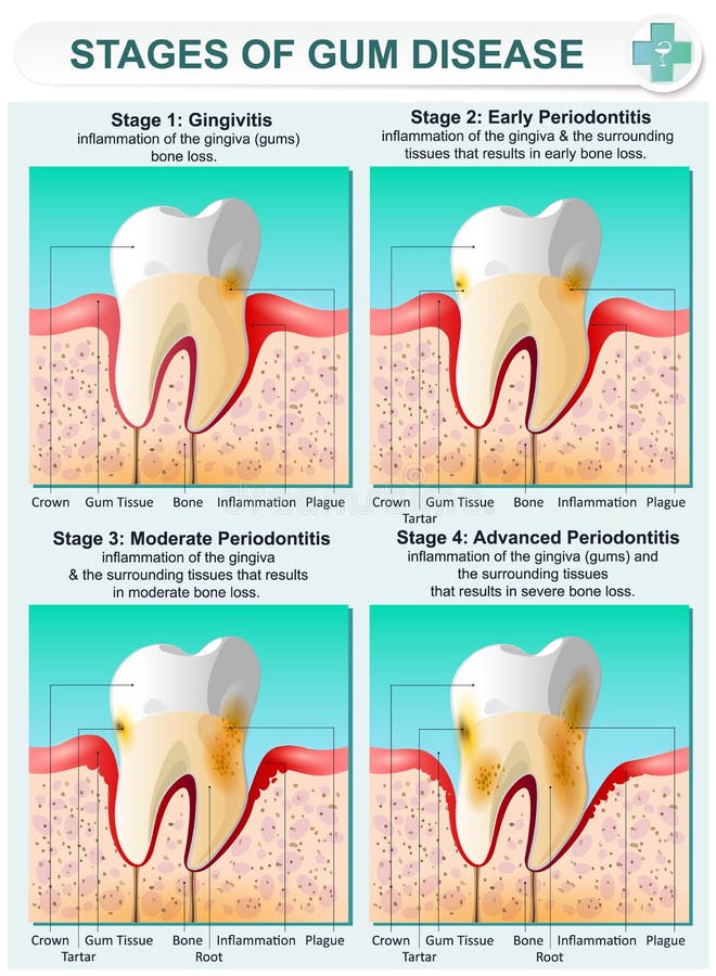 Stage of Gum Disease. Vector detailed illustration of the stages of gum disease. Image of teeth and gums in a section of bone tissue with affected areas and vector illustration