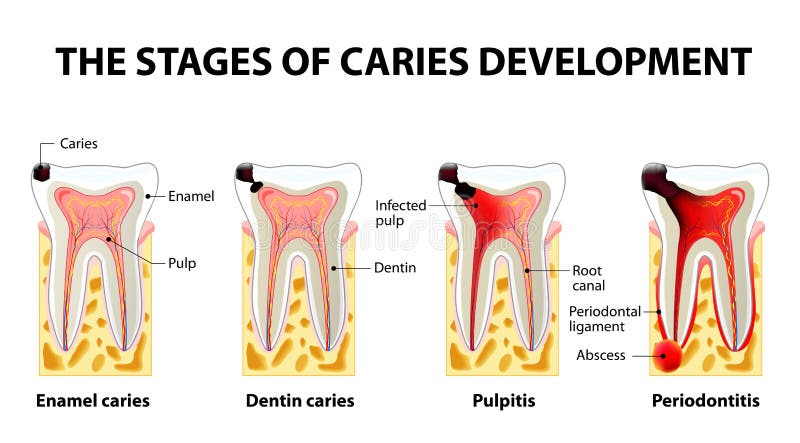 Stages of caries development. Dental disease: caries, pulpitis and periodontitis royalty free illustration