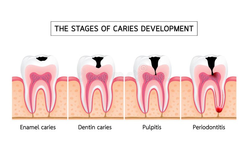 Stages of caries development. Enamel caries, Dentin caries, Pulpitis and Periodontitis. Dental care info-graphic, illustration on white background vector illustration