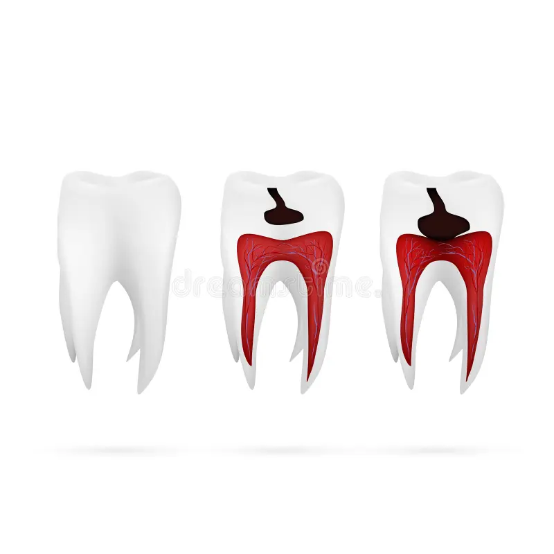 Stages Of Caries Development Isolated On White royalty free illustration