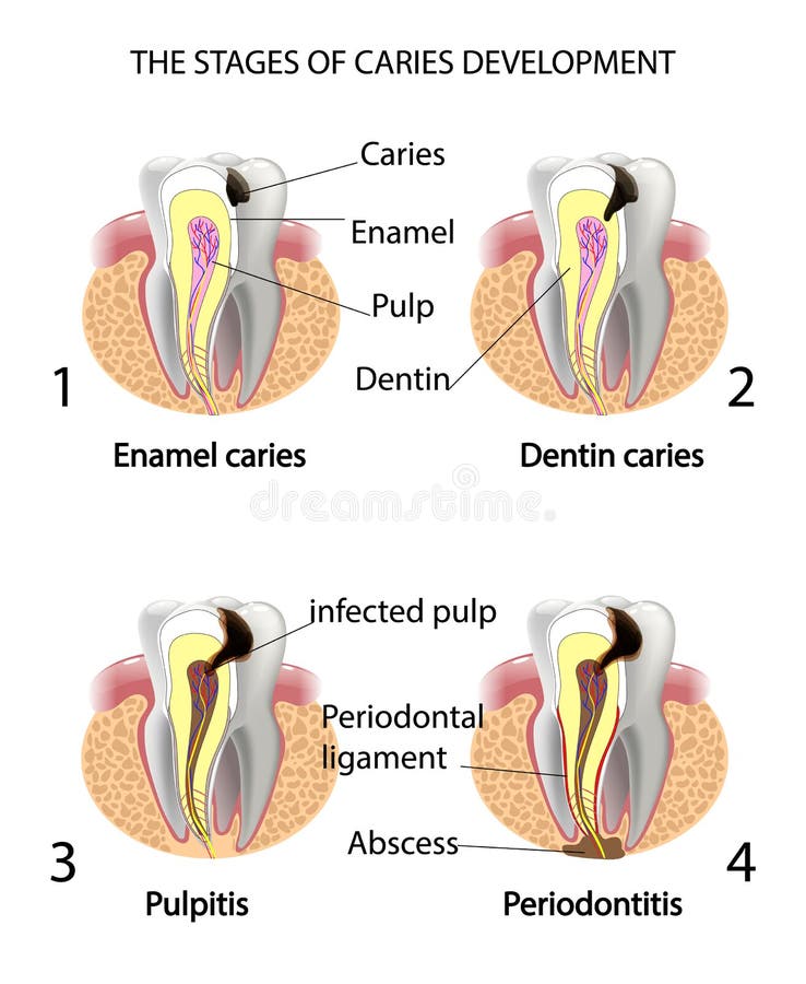 THE STAGES OF CARIES DEVELOPMENT vector illustration