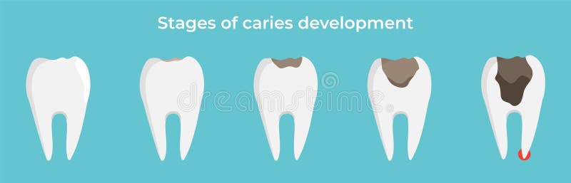 Stages of caries development, tooth dekay, dental concept, vector illustration on blue background. stock illustration