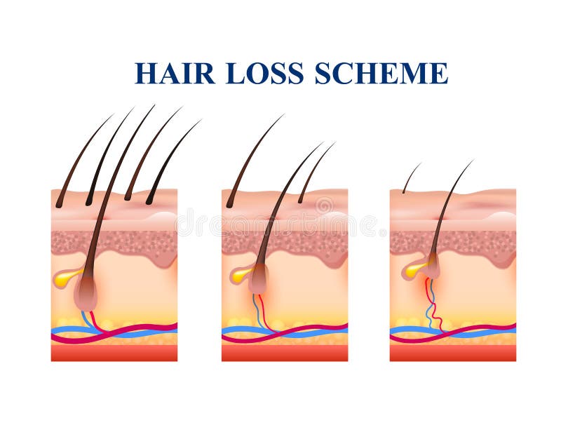 Hair Loss Scheme royalty free illustration