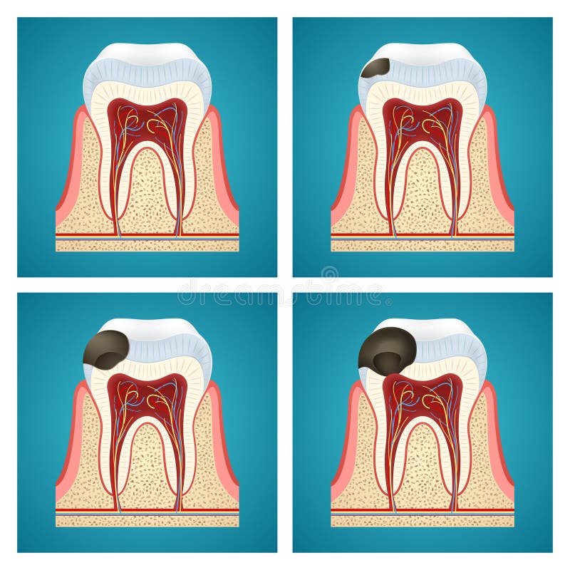 Stages progress caries on human teeth. On blue background royalty free illustration