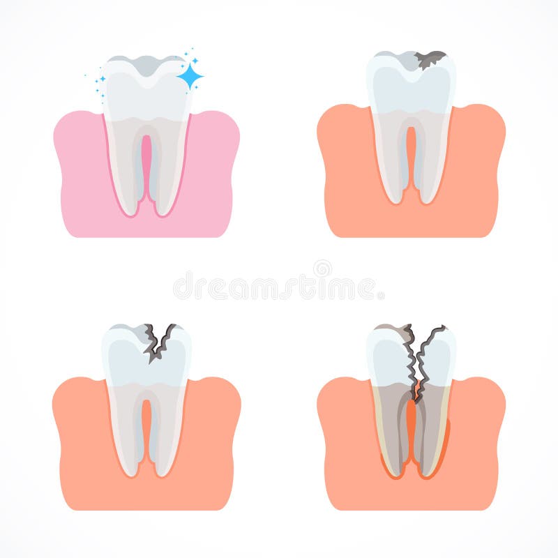 Stages of tooth decay with caries. Dentistry and oral care. Flat vector cartoon illustration. Objects isolated on white background royalty free illustration