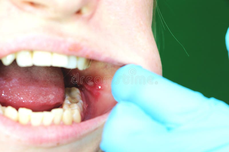 Painful ulcer and stomatitis on the mucous cheek of a girl. After the operation to remove the wisdom teeth. Stitches and. Stitches and postoperative period stock images