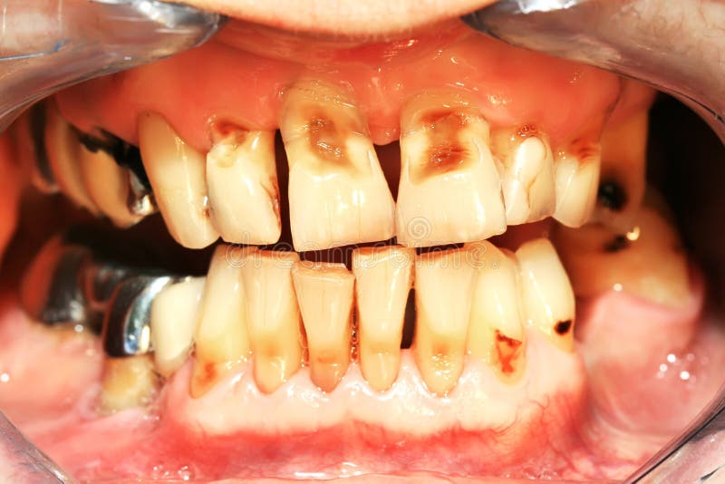 Teeth abrasion stock images