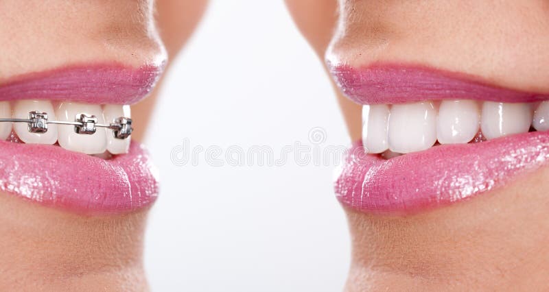 Teeth with braces royalty free stock images