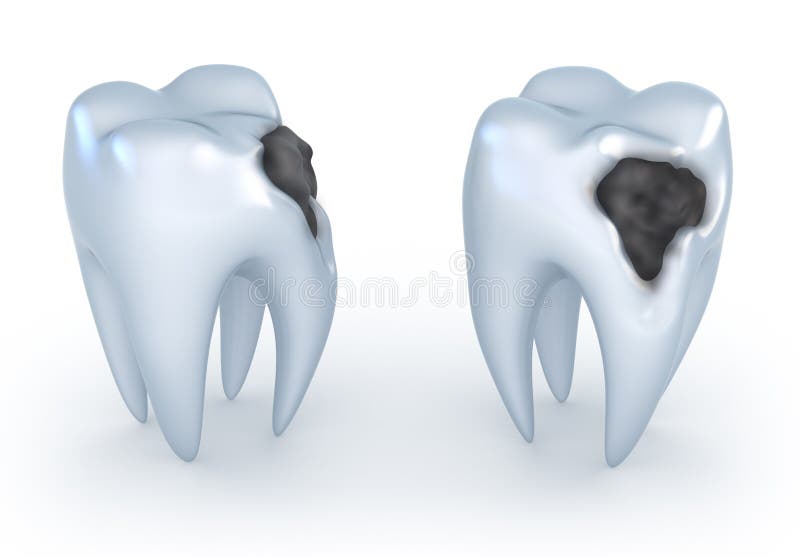 Teeth with caries. 3D image royalty free illustration