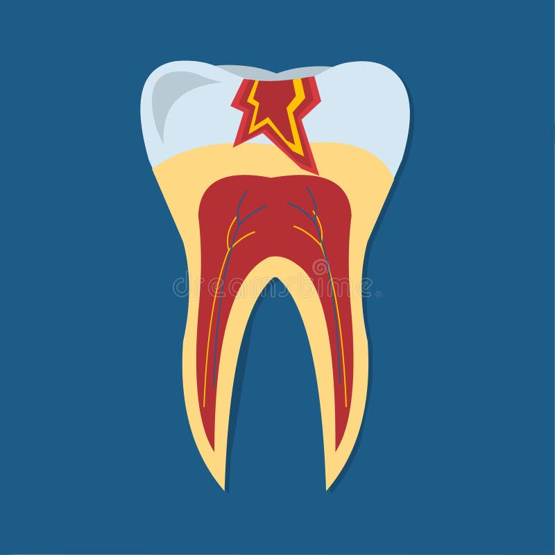 Teeth caries concept vector symbol illustration.  royalty free illustration