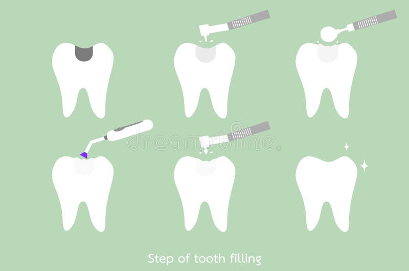 Step of caries to tooth amalgam filling with dental tools. Teeth cartoon vector flat style for design - step of caries to tooth amalgam filling with dental tools vector illustration