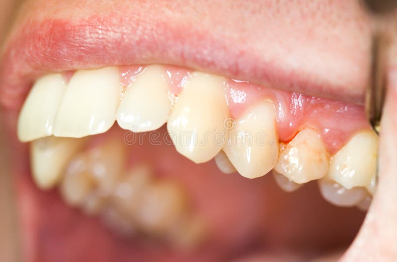 Teeth and gingivitis stock photos