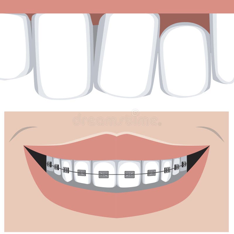 Teeth and malocclusion on the upper jaw, flat vector stock illustration with molars and incisors and braces as a concept of dental. Teeth with malocclusion on royalty free illustration