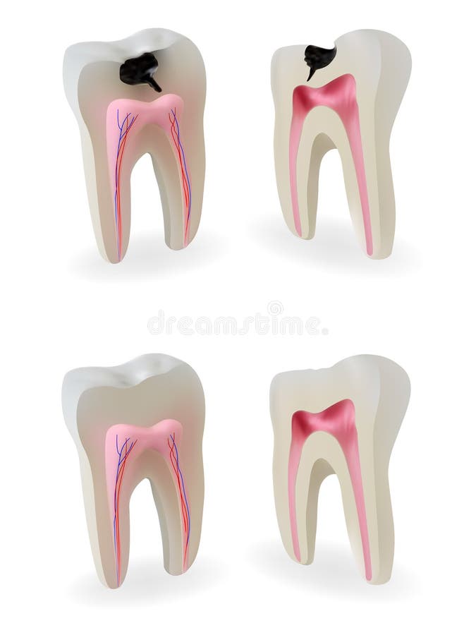 Teeth models. Sound teeth and teeth with caries in section royalty free illustration