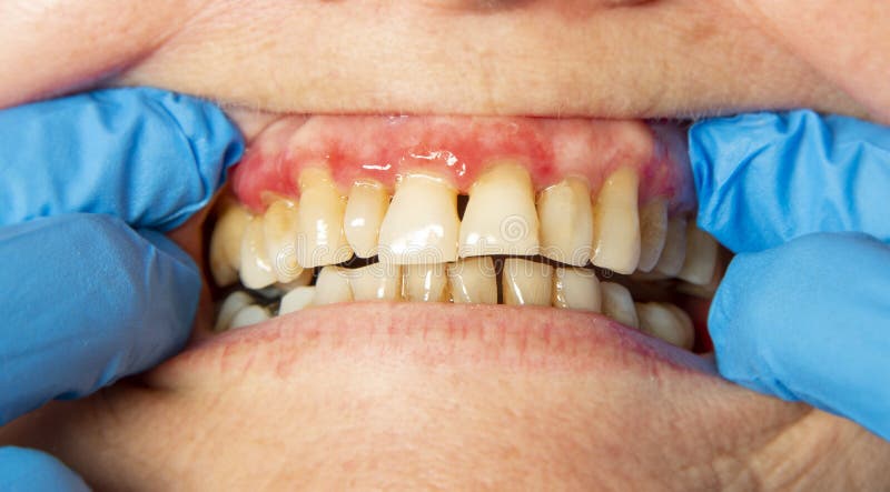 Teeth with periodontitis. Close up stock photography