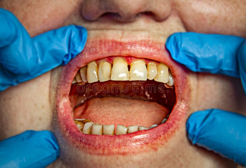 Teeth with periodontitis. Close up royalty free stock photo Teeth with periodontitis. Close up royalty free stock photo