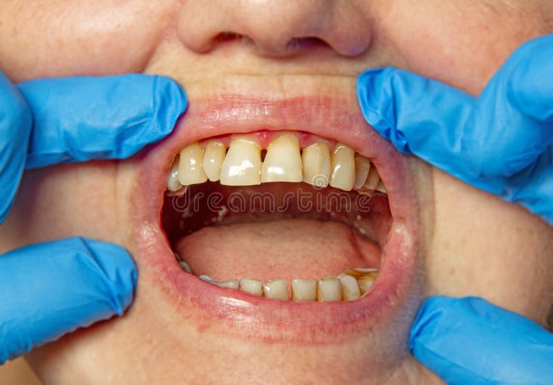 Teeth with periodontitis. Close up royalty free stock photos Teeth with periodontitis. Close up royalty free stock photos