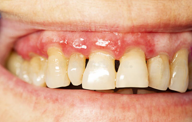 Teeth with periodontitis. Close up stock photography Teeth with periodontitis. Close up stock photography