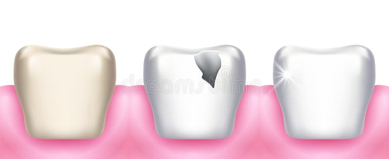 Teeth problems. Tooth decay, dental diseases, infection caries and enamel destruction. Professional clean or whitening. Realistic 3d stomatology vector stock illustration