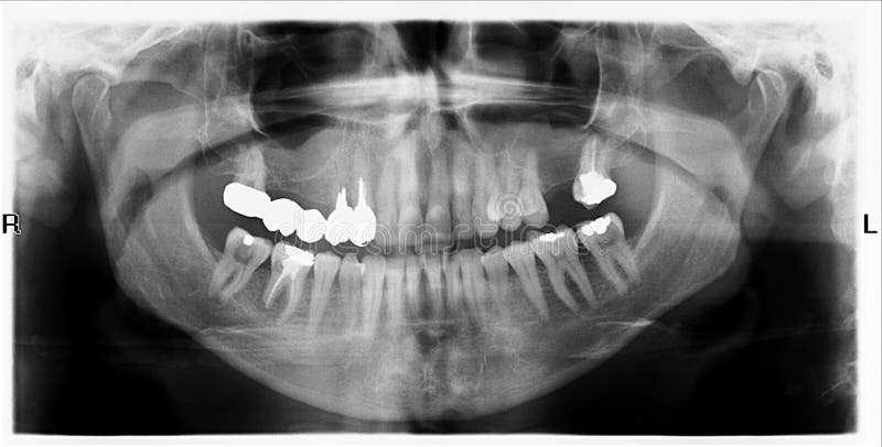 Teeth on X-Ray Image stock photography