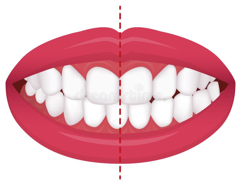 Teeth trouble  bite type / crooked teeth  vector illustration  /Crossbite misalignment vector illustration