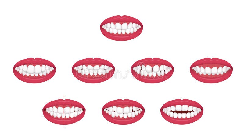 Teeth trouble  bite type / crooked teeth  vector illustration set royalty free illustration