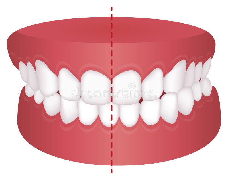 Teeth trouble  bite type  vector illustration / Crossbite misalignment. Teeth trouble  bite type  vector illustration /Crossbite     / misalignment stock illustration