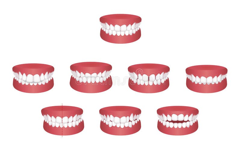 Teeth trouble  bite type  vector illustration set. Teeth trouble bite type vector illustration set vector illustration