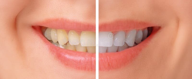 Teeth before and after whitening royalty free stock photo