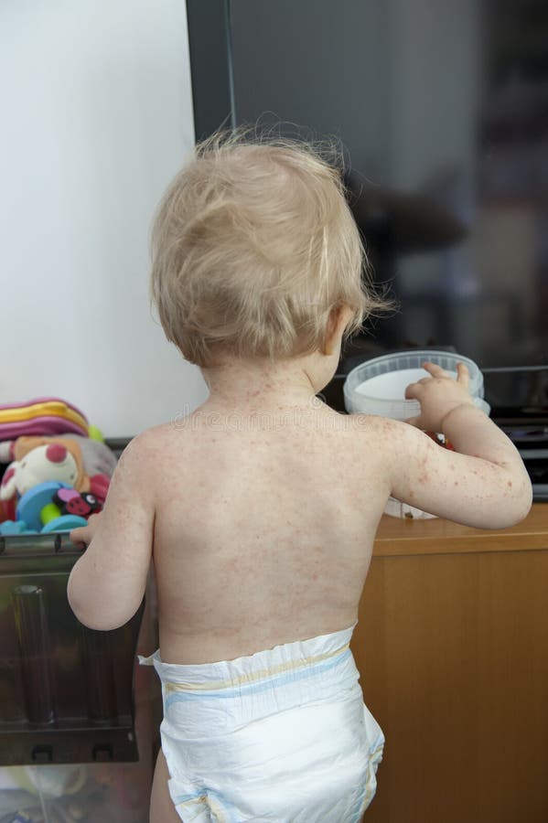 Toddler with hand , foot and mouth disease. Indoors stock photo