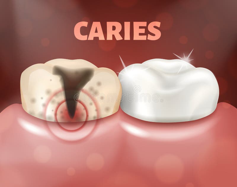 Tooth with caries and healthy tooth. 3d realistic illustration of dental disease. Deep caries on a sick tooth. Tooth with caries and healthy tooth. 3d realistic stock illustration