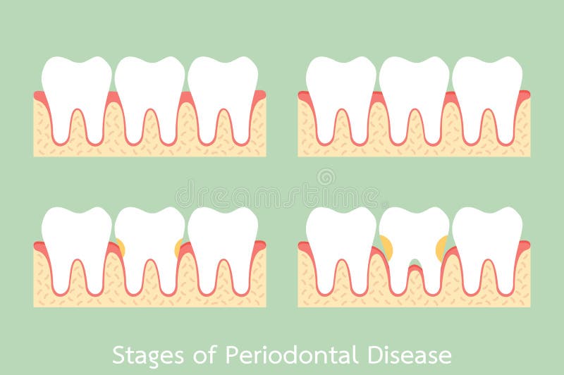 Step of periodontal disease / periodontitis / gingivitis / gum disease, dental problem. Tooth cartoon vector flat style for design - step of periodontal disease vector illustration