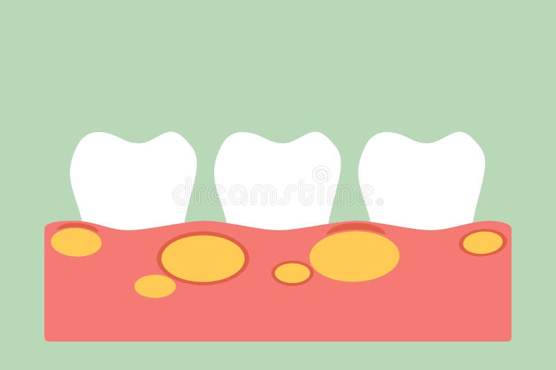 Unhealthy teeth because gingivitis with abscess in gum and dental plaque or tartar. Tooth cartoon vector flat style for design - unhealthy teeth because stock illustration