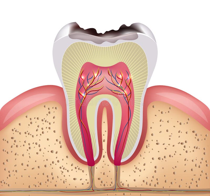 Tooth cross section with dental caries. Detailed illustration royalty free illustration